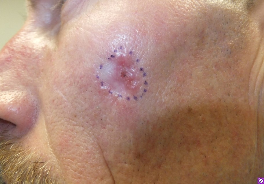 Figure 4 C, Infiltrating and micronodular basal cell carcinoma (BCC)